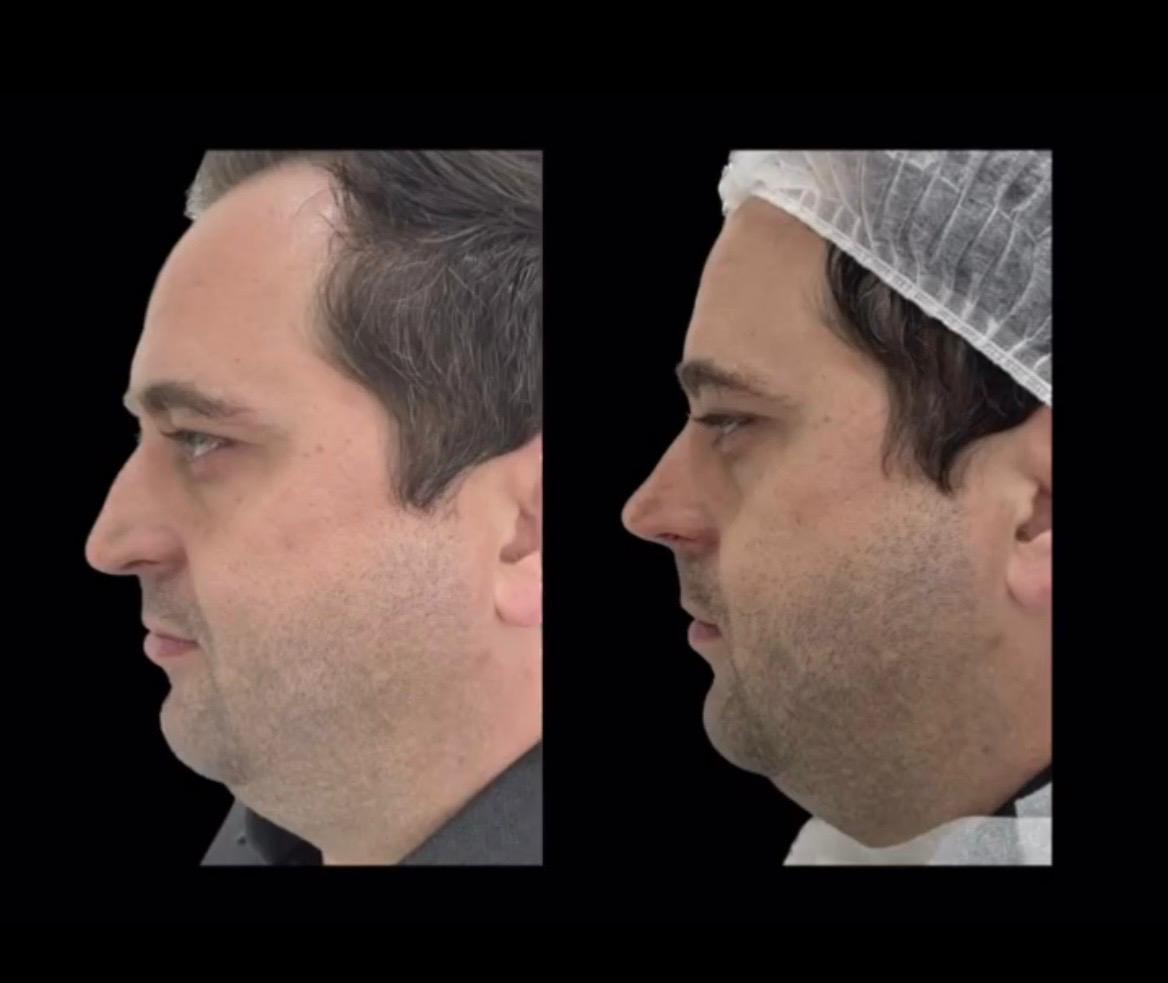 Resultado de rinoplastia
