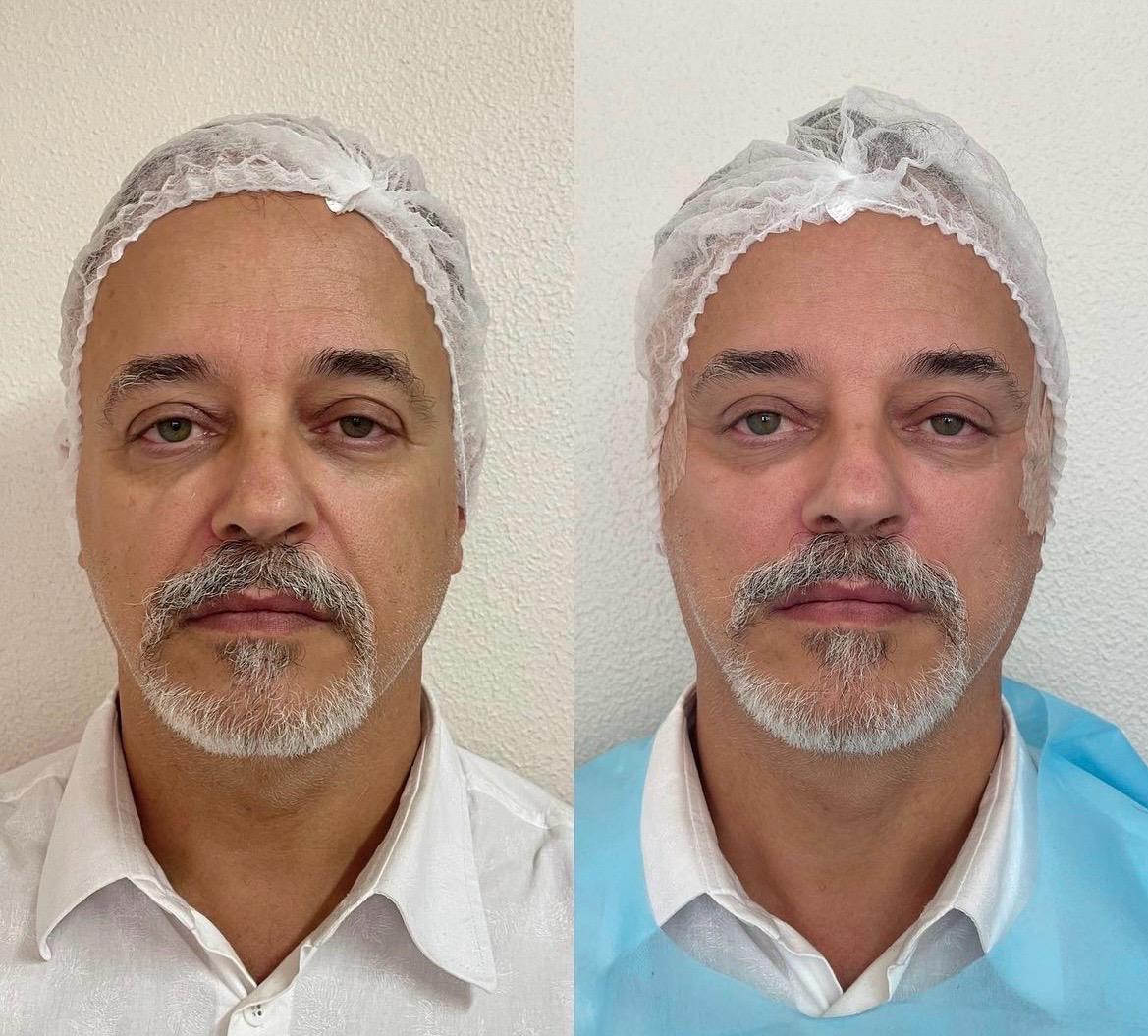 Resultado de lifting facial