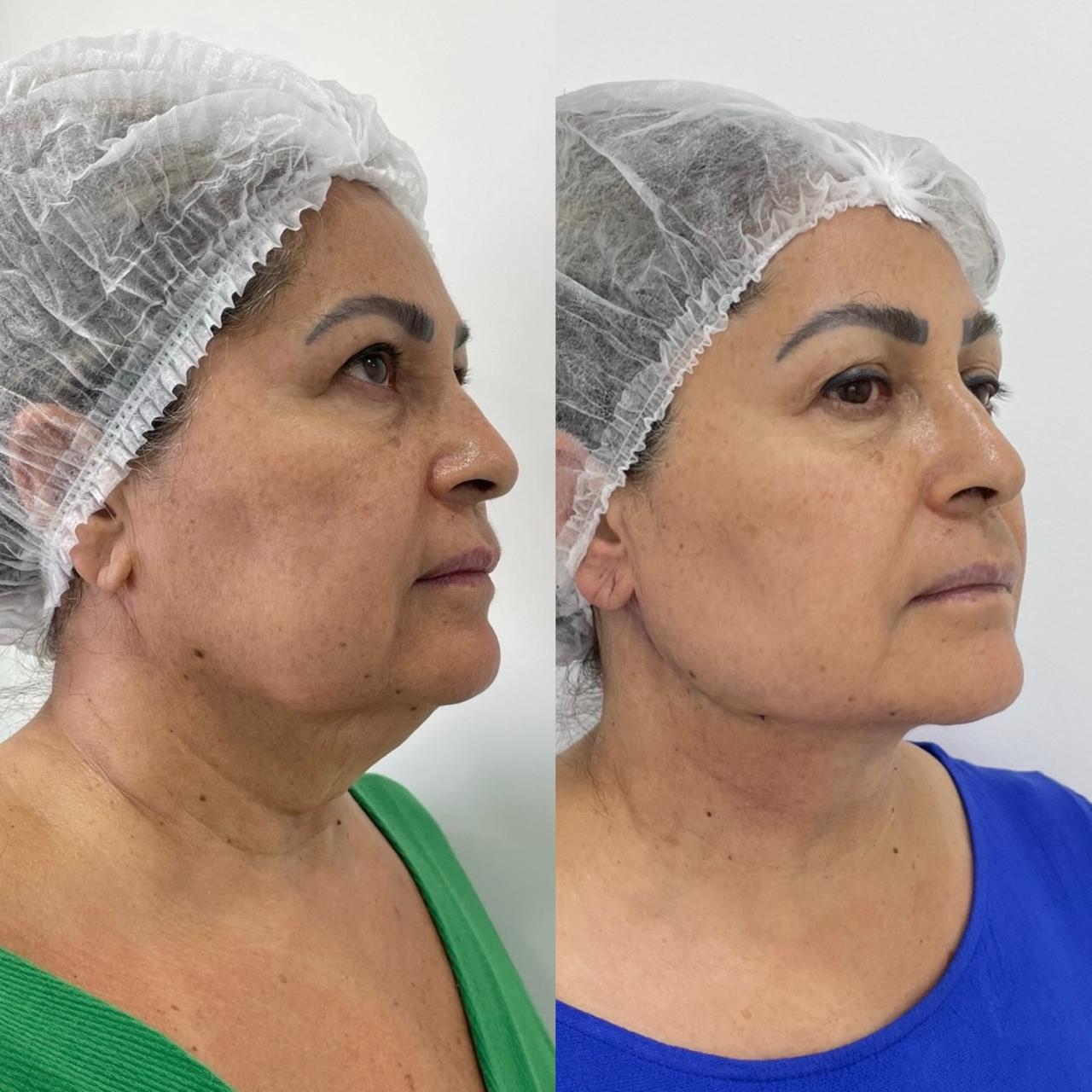 Resultado de lipo de papada, platismoplastia e cervicoplastia em paciente acima de 60 anos