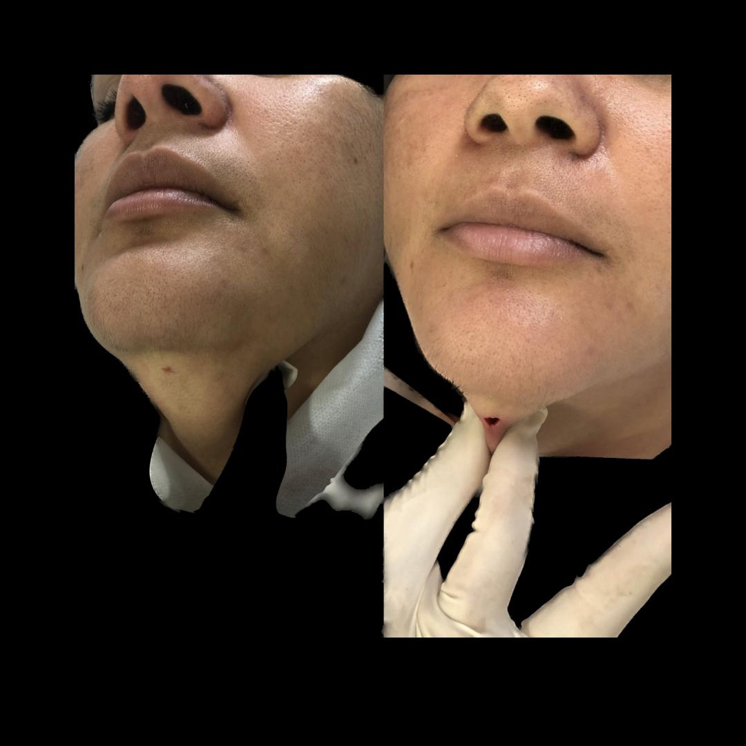 Resultado de bichectomia e lipo de papada
