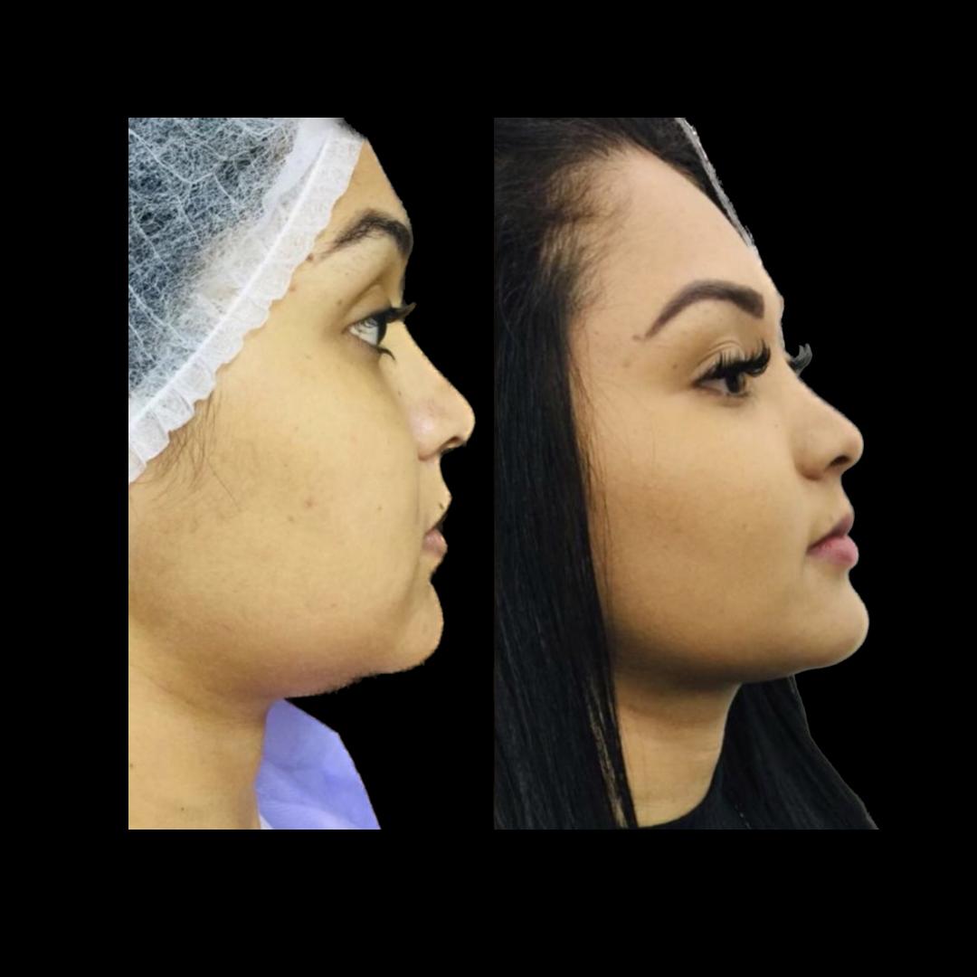 Resultado de otoplastia