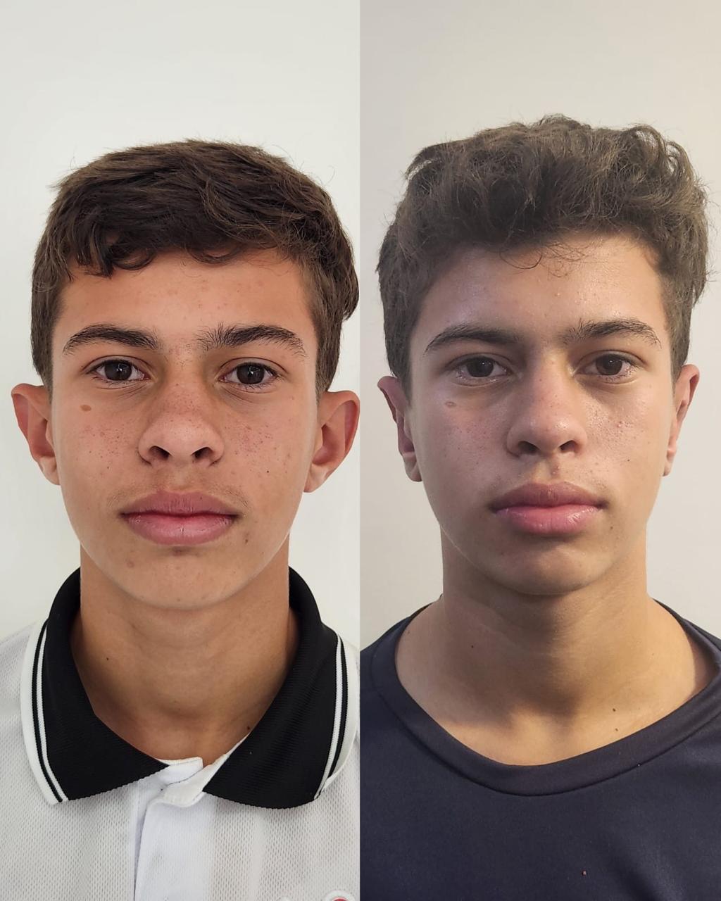 Resultado de blefaroplastia